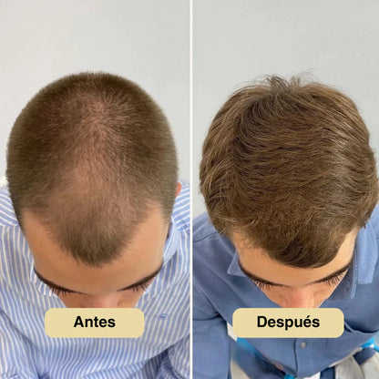 Roll-on de Crecimiento Capilar StyleofYou™